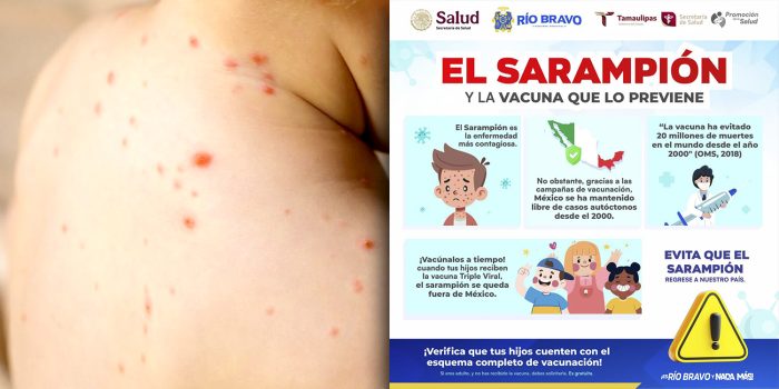 Piden tomar medidas en Río Bravo, ante brotes de sarampión en el país